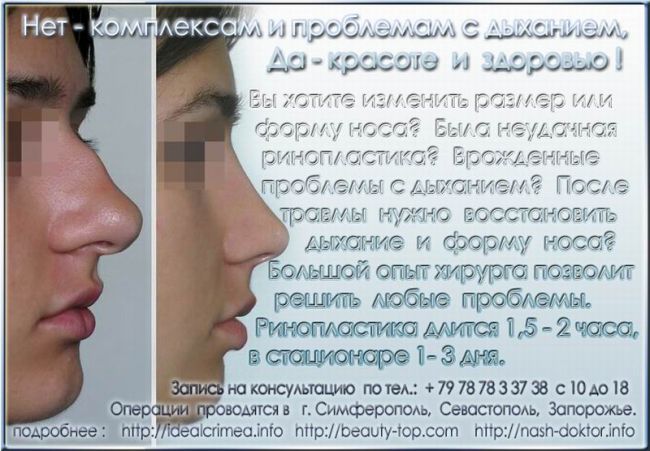 Ринопластика изменить размер или форму носа Крым